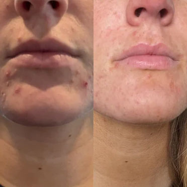 Hailey H. before and after